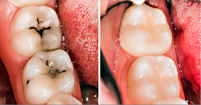 Байгалийн аргаар шүд цоорох өвчнийг анагаах 8 энгийн арга- Эмнэлэг рүү явахаас айж байвал үүнийг туршаарай