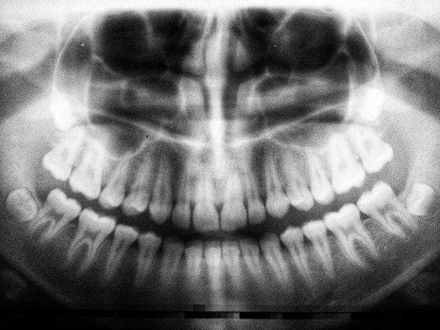 7 настай хүүгийн 80 шүдийг амжилттай авчээ-Яагаад?